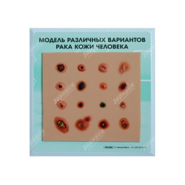 Модель различных вариантов рака кожи человека